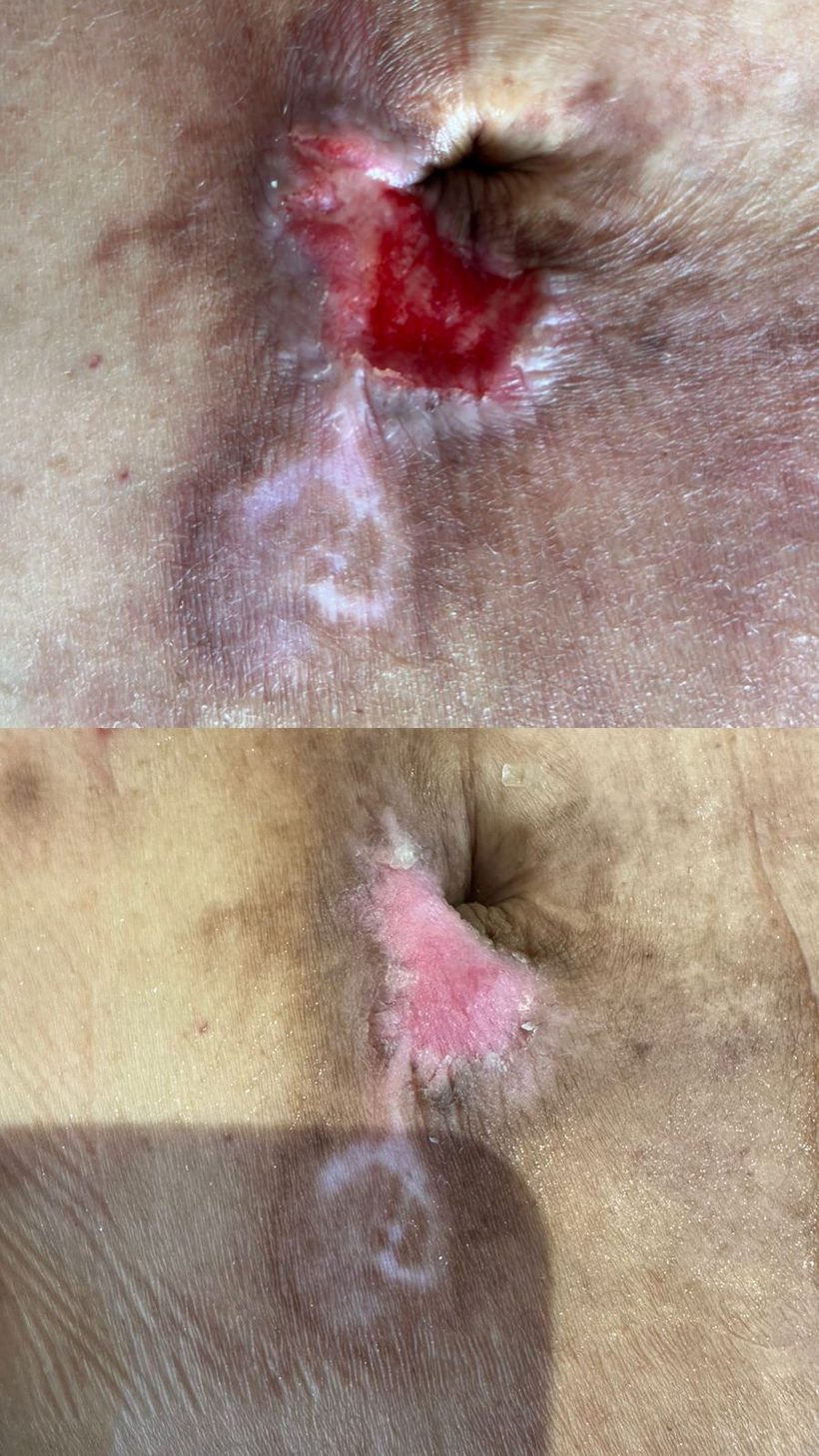 Caso real de cicatrização de ferida acompanhado pela RAC VitalCure — antes e depois