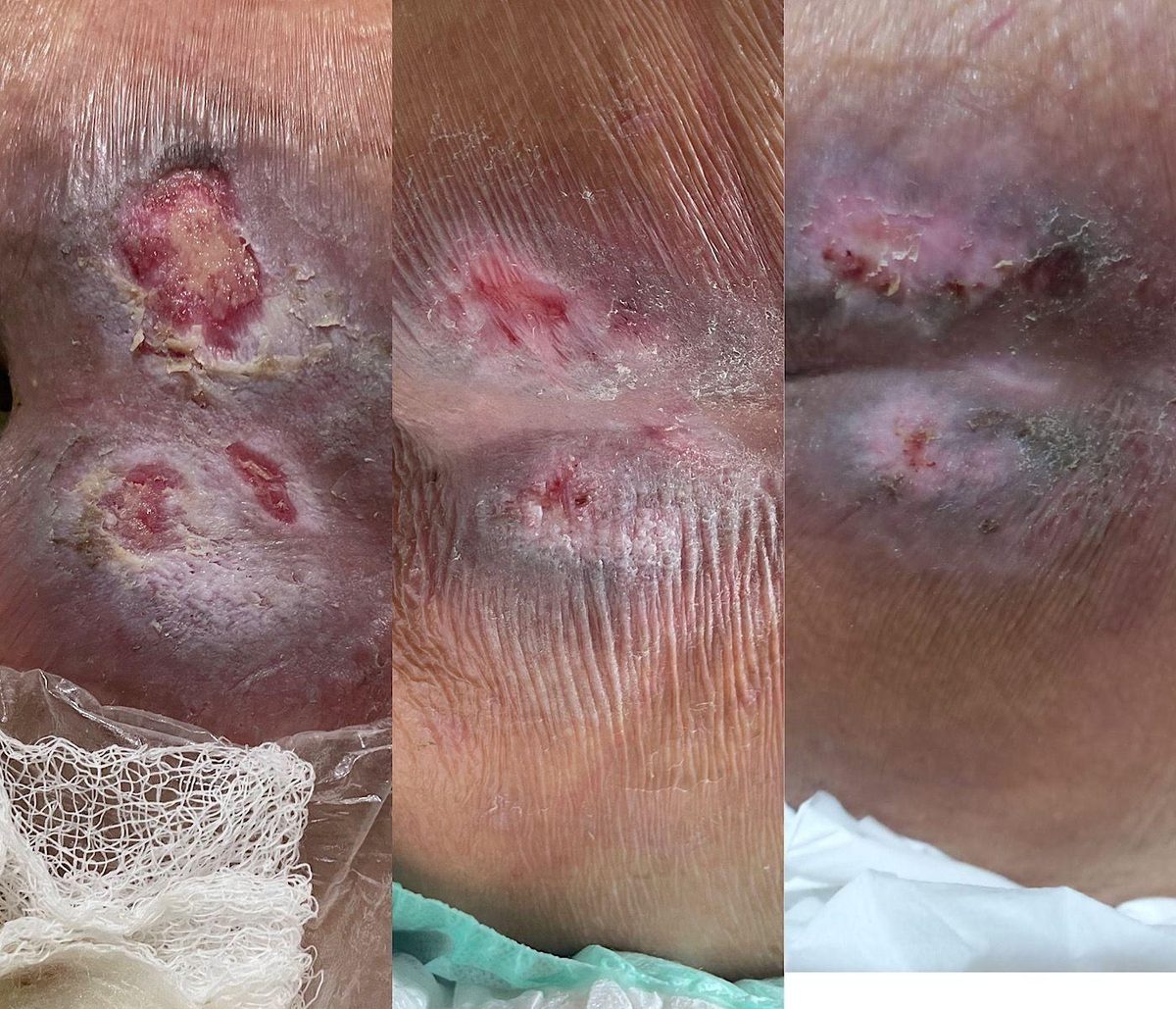 Caso real de cicatrização de ferida acompanhado pela RAC VitalCure — antes e depois