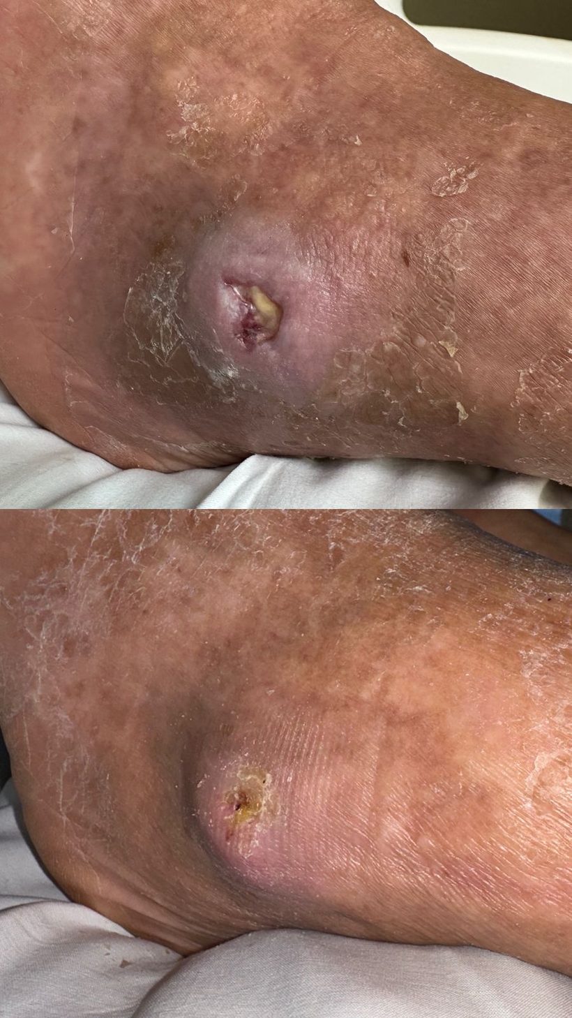 Caso real de cicatrização de ferida acompanhado pela RAC VitalCure — antes e depois