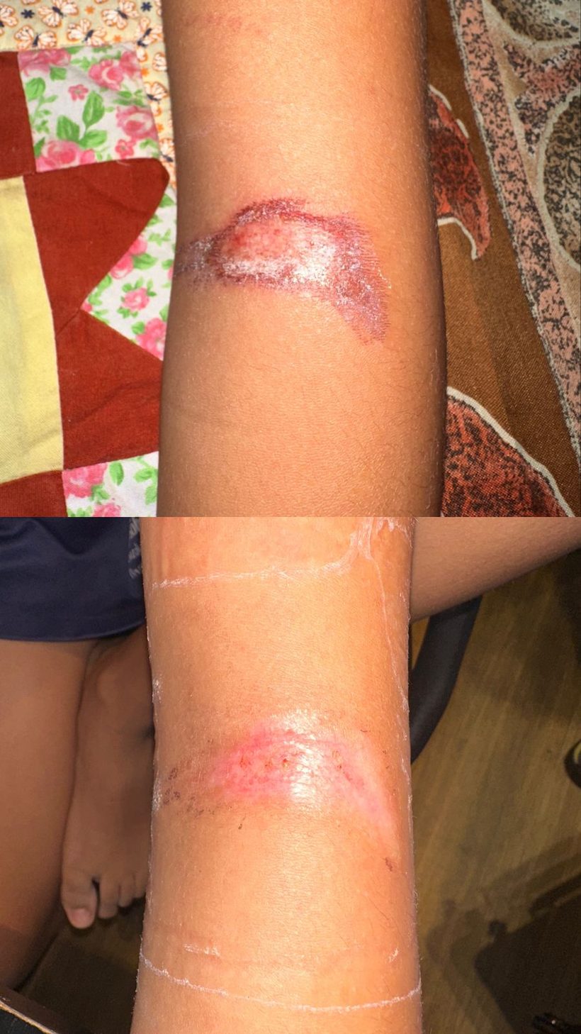 Caso real de cicatrização de ferida acompanhado pela RAC VitalCure — antes e depois