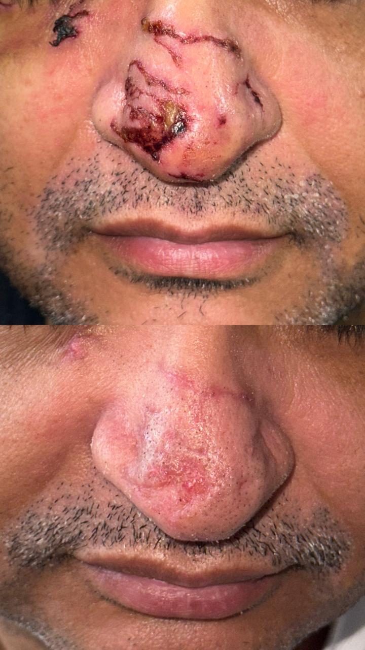 Caso real de cicatrização de ferida acompanhado pela RAC VitalCure — antes e depois