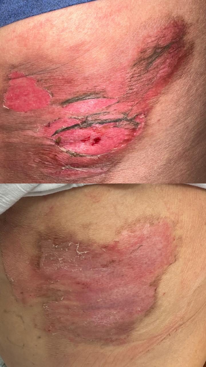 Caso real de cicatrização de ferida acompanhado pela RAC VitalCure — antes e depois