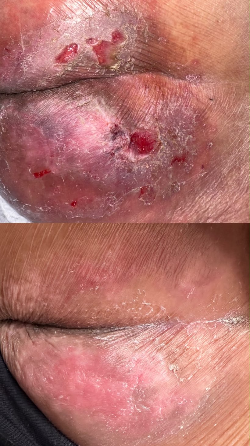 Caso real de cicatrização de ferida acompanhado pela RAC VitalCure — antes e depois